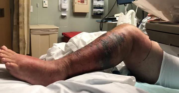 Autoridades alertan sobre riesgo de infección grave por Vibrio vulnificus, con posibilidad de muerte en 48 horas.